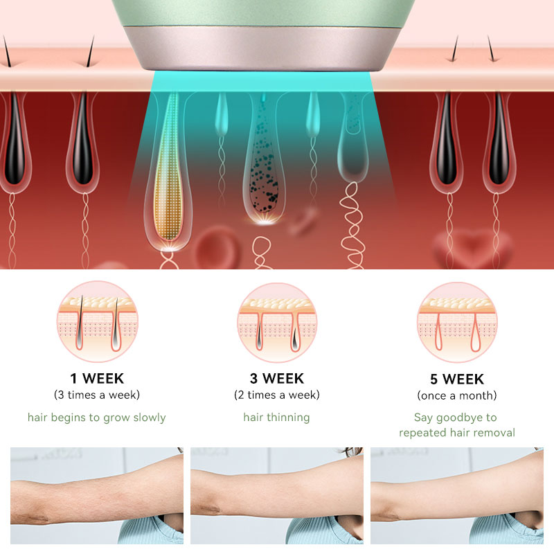 SKB 2128-Ipl Laser Hair Removal Portable Hair Removal Device